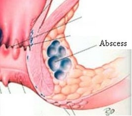 Anorectal Diseases 15 anal abscess custom size 267 234