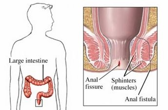 Anorectal Diseases 14 analfissure