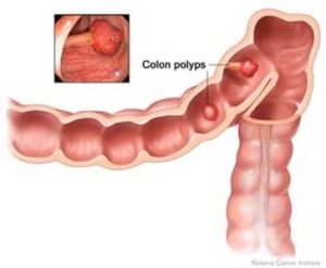 Anorectal Diseases 12 colon polyps custom size 364 300