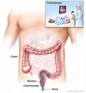 colonscopy procedure custom size 361 390