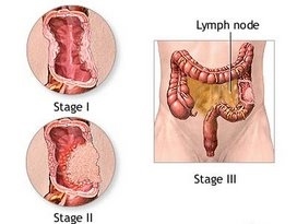 colon cancer stage 0