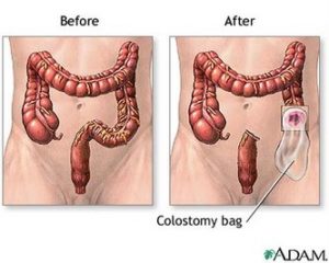 Enterostomal Therapy 5 colostomy4 custom size 333 267