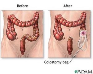 colostomy4 custom size 333 267