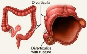 diverticulitis custom size 354 219