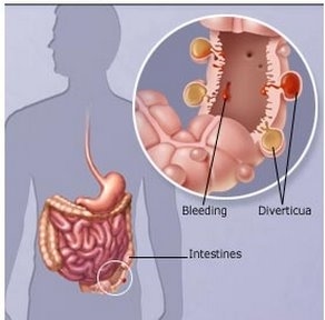 Diverticulitis/Diverticulosis 5 diverticulosis custom size 297 328 crop 0 0 07 0 99 0 95