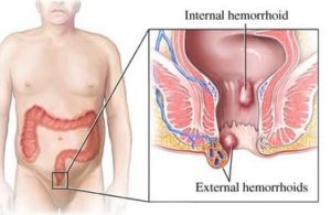 hemorrhoids custom size 374 243