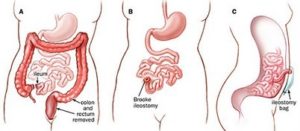 Enterostomal Therapy 6 ileostomy custom size 402 177