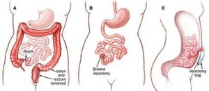 ileostomy custom size 402 177