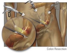laparoscopic surgery custom size 282 224