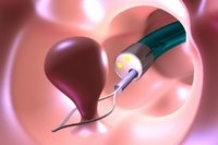 Colon Polyps 2 polyp removal medium