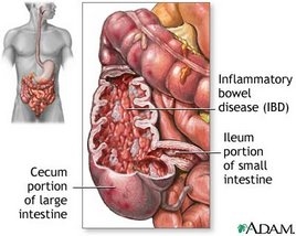 ulcerative colitis custom size 268 214